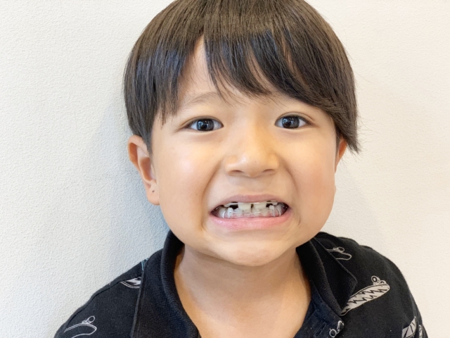 子供の矯正で抜歯を選ぶ前に考えたいこと｜後悔しないためのポイントを歯科医が解説します