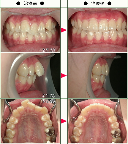 出っ歯矯正症例(小出様　１８歳　女性)
