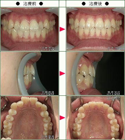 歯のデコボコ矯正症例(小泉様　２６歳　女性)