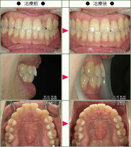歯のデコボコ矯正症例(Ｋ　olive様　３７歳　女性)