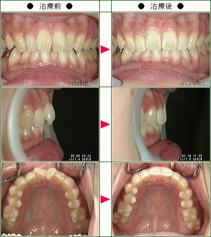 歯のデコボコ矯正症例(こりらっくま様　３５歳　女性)