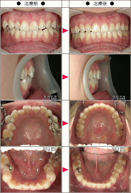 歯のデコボコ矯正症例［こっとん様　２２歳　女性］