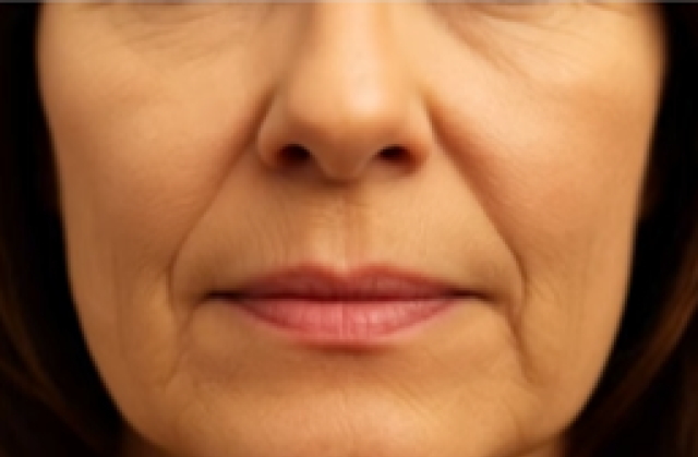 法令線（ほうれい線）が目立つようになる