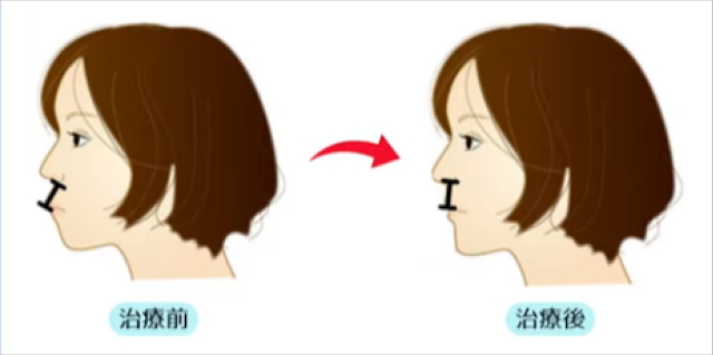 鼻の下（人中）が長く見える