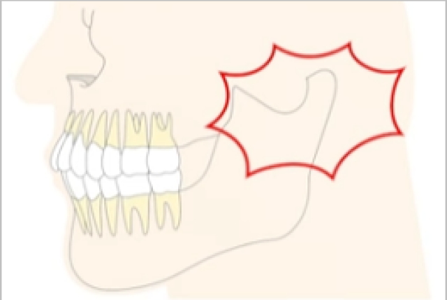 顎関節症（あごの関節のトラブル）のリスク