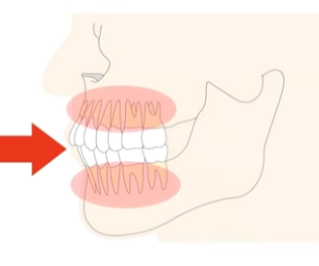 歯の根っこが短くなる（歯根吸収）