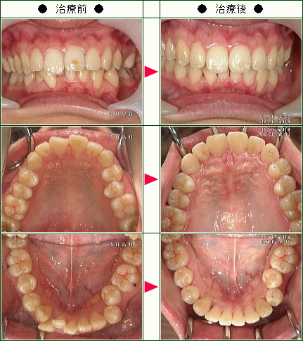 歯のデコボコ矯正症例(Ｋ．Ｒ様　２４歳　女性)