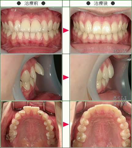 出っ歯矯正症例(Ｋ．Ｓ様　２０歳　女性)