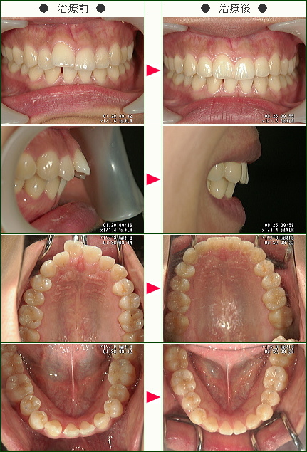 出っ歯矯正症例(Ｋ.Ｓ.様　２３歳　女性)