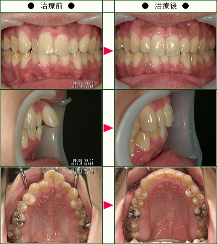 出っ歯矯正症例(Ｋ・Ｓ様　２３歳　男性)