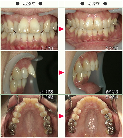 出っ歯矯正症例(Ｋ・Ｓ様　４２歳　女性)