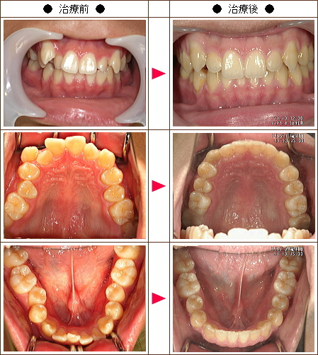 歯のデコボコ矯正症例［Ｋ・Ｔ様　２２歳　男性］