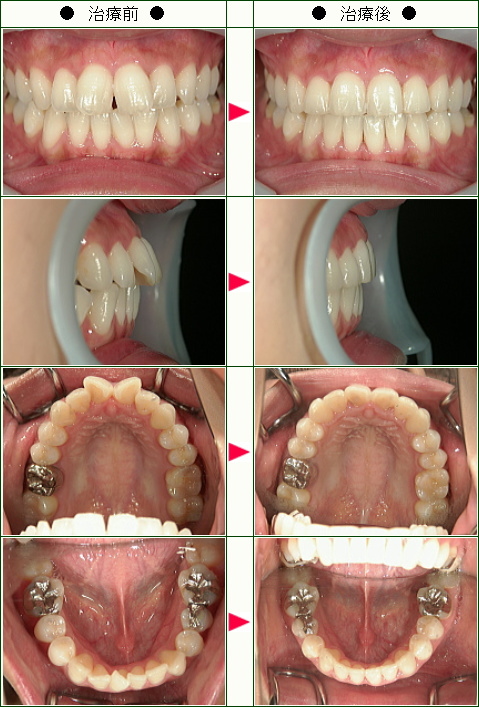 歯のデコボコ矯正症例(Ｋ．Ｔ様　２５歳　女性)