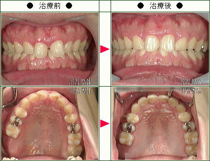 前歯のすきっ歯矯正症例(Ｋ.Ｔ様　２５歳　男性)