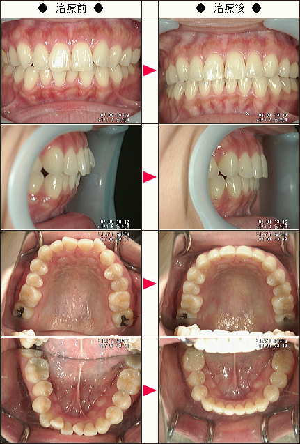 歯のデコボコ矯正症例［Ｋ.Ｔ様　３３歳　女性］
