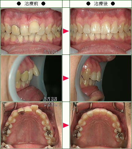 歯のデコボコ矯正症例(Ｋ・Ｔ様　３６歳　男性)
