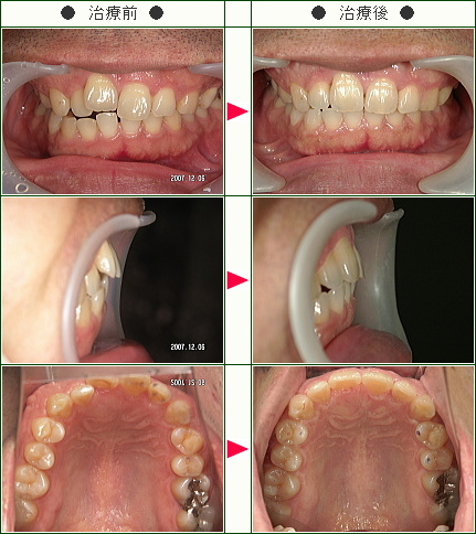 出っ歯矯正症例(Ｋ.Ｔ.様　３８歳　男性)