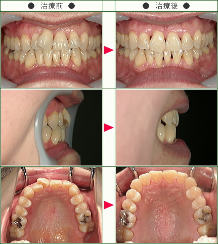 歯のデコボコ症例(Ｋ・Ｔ様　４８歳　女性)