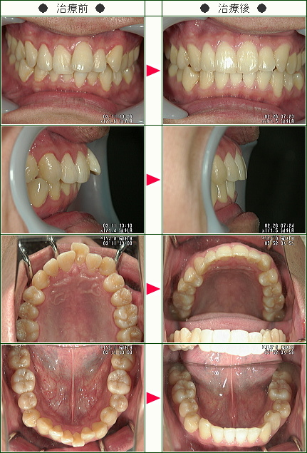 歯のデコボコ矯正症例(Ｋ．Ｕ様　３０歳　男性)
