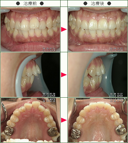 出っ歯矯正症例(Ｋ・Ｕ様　３７歳　女性)