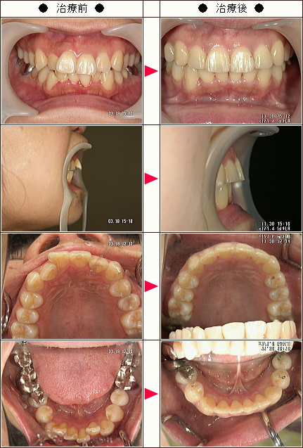 出っ歯矯正症例［久保様　３９歳　女性］