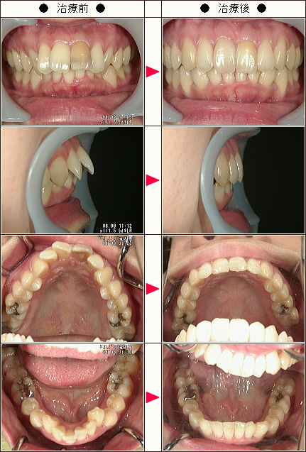 出っ歯矯正症例［Ｋ.Ｙ様　３０歳　女性］