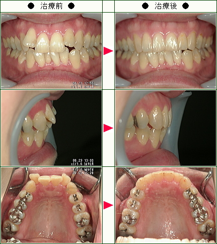歯のデコボコ矯正症例(Ｋ．Ｙ様　３３歳　女性)