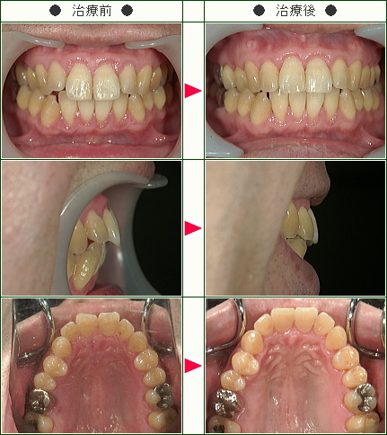 出っ歯矯正症例(ＫＹ様　４４歳　男性)