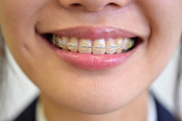 大きい前歯を歯列矯正で治す方法