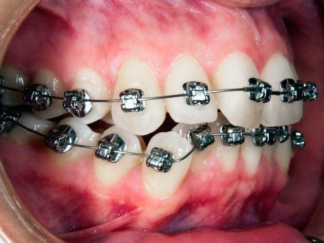 装置による痛みや違和感