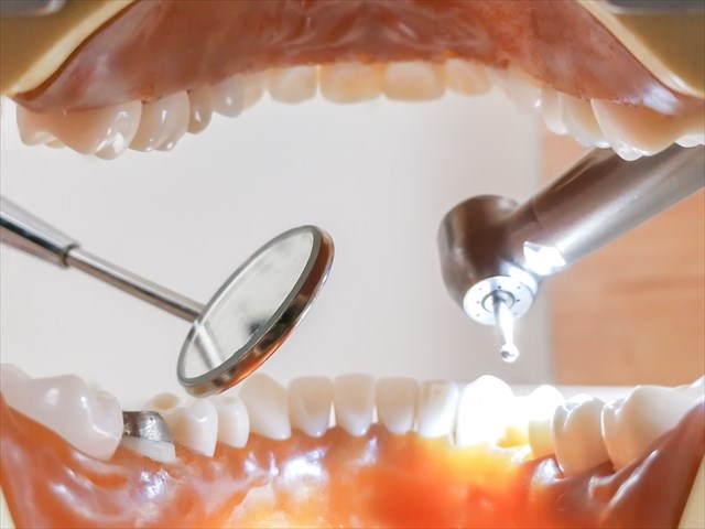 すきっ歯の矯正治療の種類
