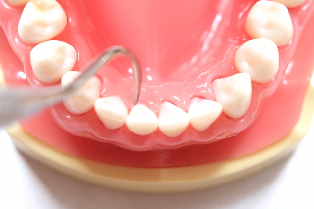 矯正治療と歯石の関係を歯科医が解説｜歯石が矯正治療に与える影響もご紹介