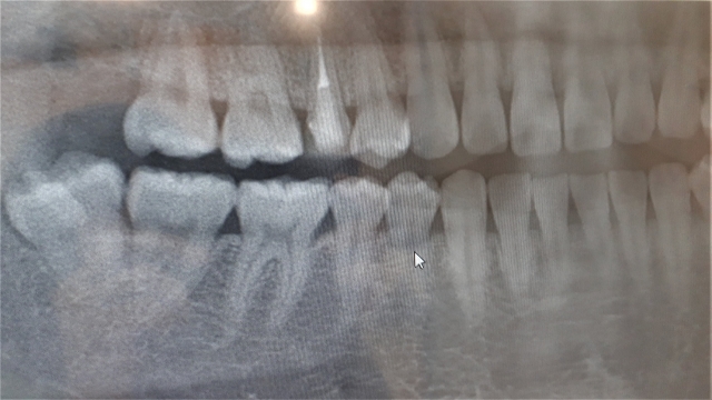 歯科矯正で奥歯を起こすことはできるのか？