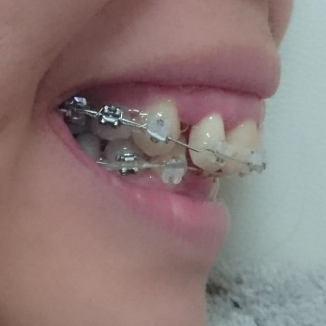 前歯の突出を改善
