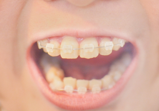 歯列矯正でブラックトライアングルができるか解説