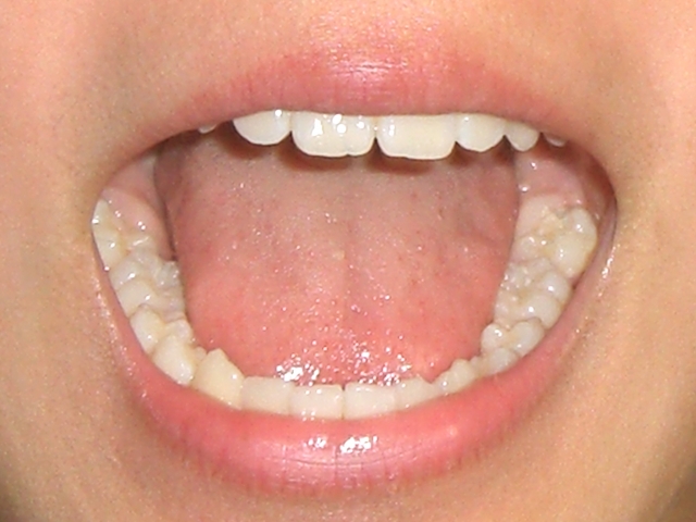 40代からの歯列矯正はお口の健康次第