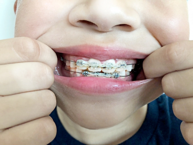 子供の歯並びを矯正する際の注意点