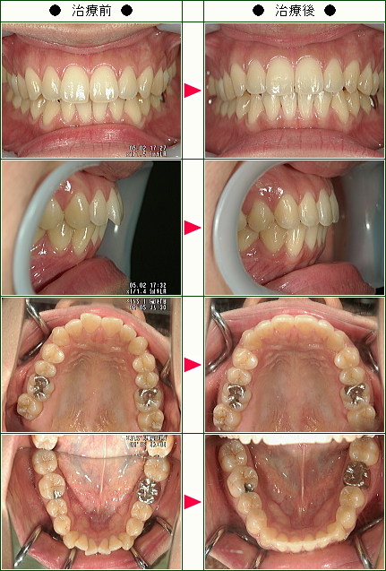 歯のデコボコ矯正症例(Ｌ.Ｍ様　２８歳　女性)
