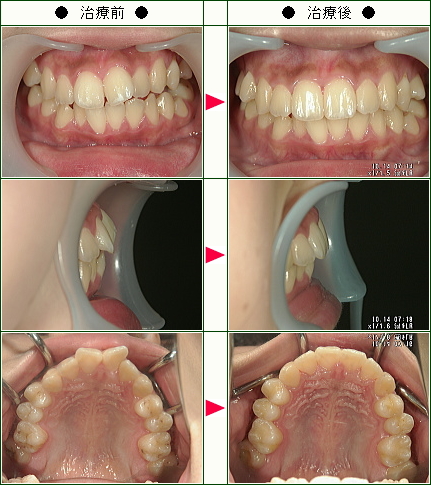 歯のデコボコ矯正症例(Ｍ様　２１歳　女性)