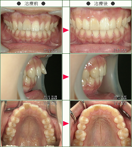 出っ歯矯正症例(ｍ様　２１歳　女性)