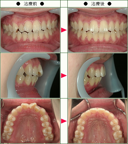歯のデコボコ矯正症例(Ｍ様　２２歳　女性)