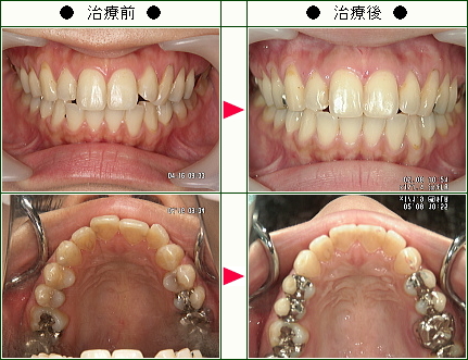 歯のデコボコ矯正症例(Ｍ様　２６歳　女性)