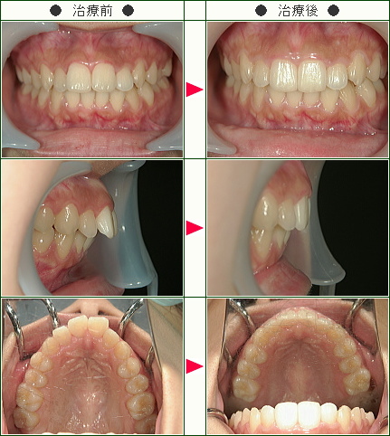出っ歯矯正症例(Ｍ様　２６歳　女性)