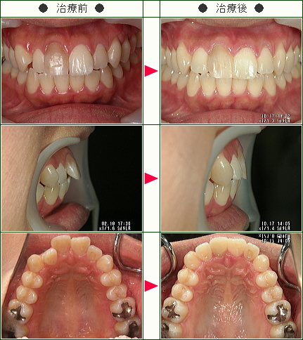 出っ歯矯正症例(Ｍ様　２８歳　女性)