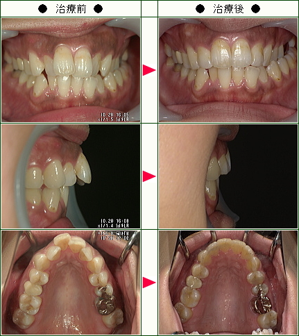 歯のデコボコ矯正症例(Ｍ様　２９歳　女性)