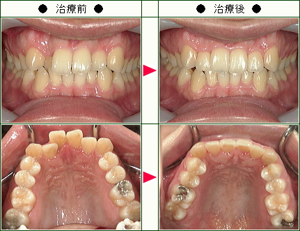 歯のデコボコ矯正症例(Ｍ様　２９歳　女性)