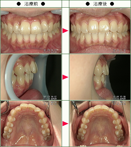 歯のデコボコ矯正症例(Ｍ様　３１歳　女性)