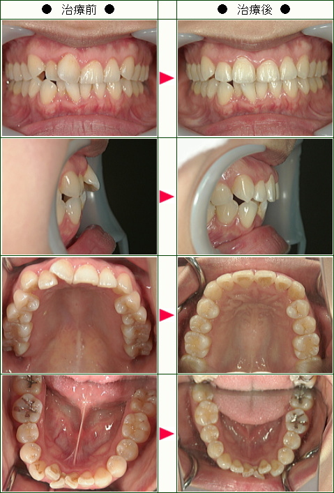 歯のデコボコ矯正症例(Ｍ様　３１歳　女性)