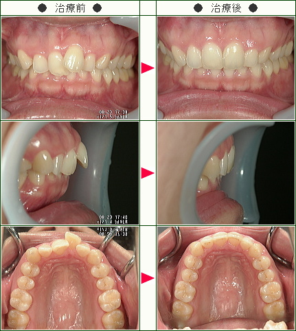 歯のデコボコ矯正症例(Ｍ様　３４歳　女性)