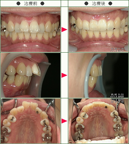 出っ歯矯正症例(Ｍ様　３７歳　女性)